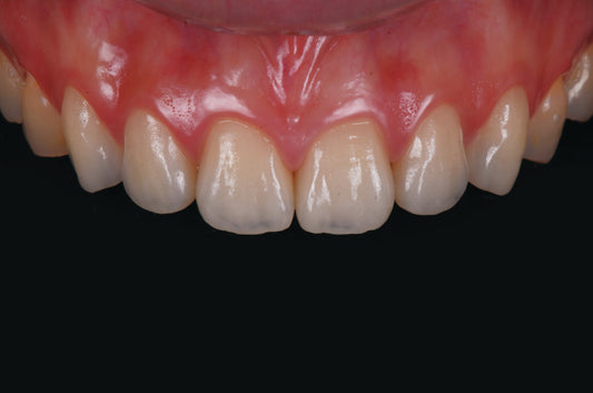 6 Common Questions Asked When Choosing a Millable Lithium-Disilicate Glass-Ceramic