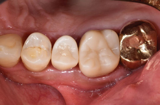 10 Things to Look for in a Nano-Hybrid Ceramic