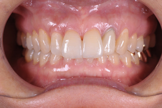 A Great Aesthetic Result: Amber Press Lithium Disilicate Laminate Veneers